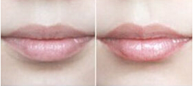 漂唇案例:恢复唇部红润颜色！
