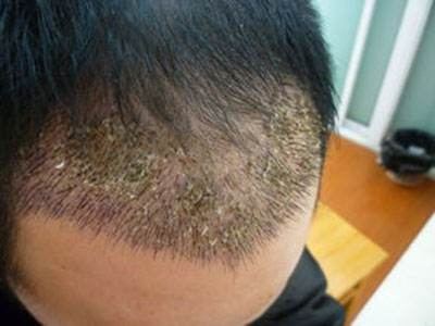 种植毛发需要多少钱
