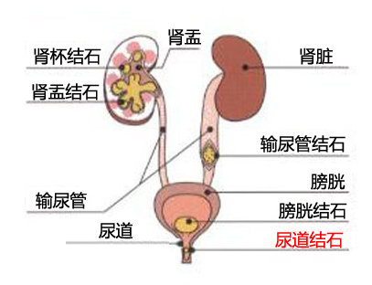 尿结石的构成要素 尿结石合适吃什么