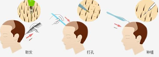 头发种植