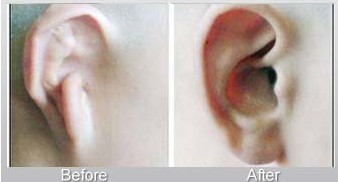 耳廓畸形矫正效果如何 增加立体的外形