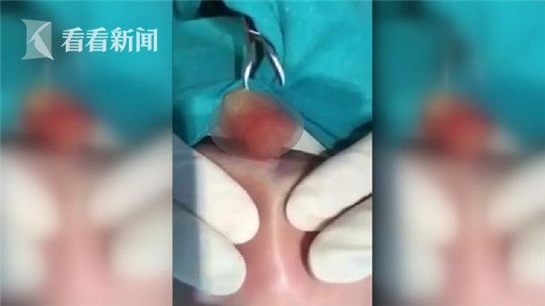 一女子整容失败化脓 头挤出膏状物