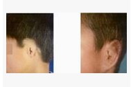 小耳或无耳再造术作用图的特征介绍