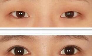 双眼皮手术案例：术后眼晴灵动美丽