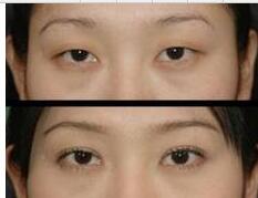 韩式双眼皮事例：眼晴变大变美丽了