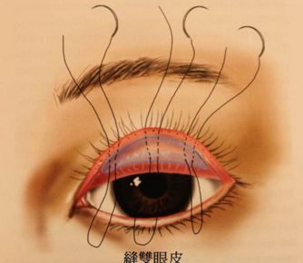 双眼皮能和祛眼袋一起做吗