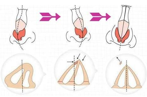 歪鼻矫正术的过程是怎样的