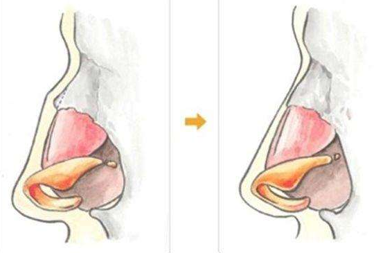 歪鼻矫正术的过程是怎样的