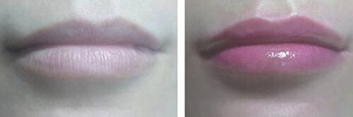 纹唇案例：小资女唇部的改变