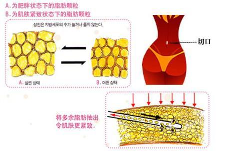 背部吸脂减肥