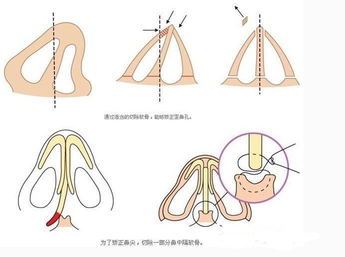 歪鼻整形手术需要多少钱