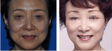 激光去除老年斑案例：在脸上见不到衰老