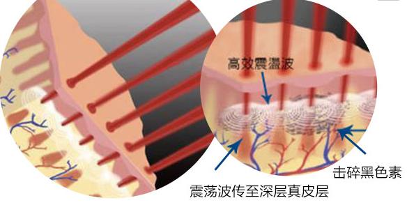 皮秒激光祛斑后有黑色素沉淀吗