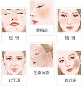蝴蝶斑和黄褐斑有什么不同