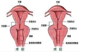 阴道紧缩案例：恢复了自信心