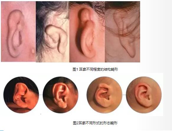 西安华京成年人能做耳廓畸形手术吗