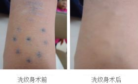 荆州第二人民医院整形激光科价格表 洗纹身后注意事项