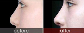 为啥隆鼻失败不可怕 杭州博雅隆鼻修复来升级