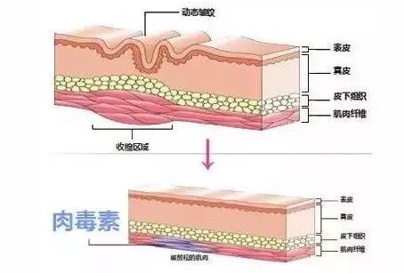 肉毒素真的有那么好吗