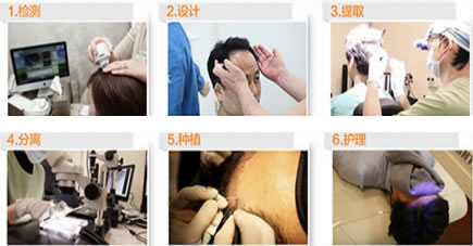 Yestar上海艺星艺术毛发移植中心手术过程