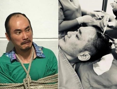 台湾男星植发手术 自爆手术过程