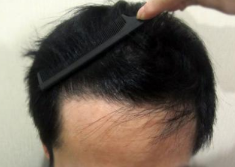 重庆欧亚发际线种植 一切从“头”开始