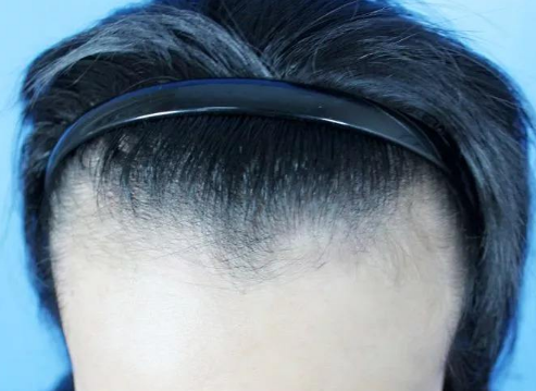 武汉天佑医院植发怎么样 发际线种植价格是多少