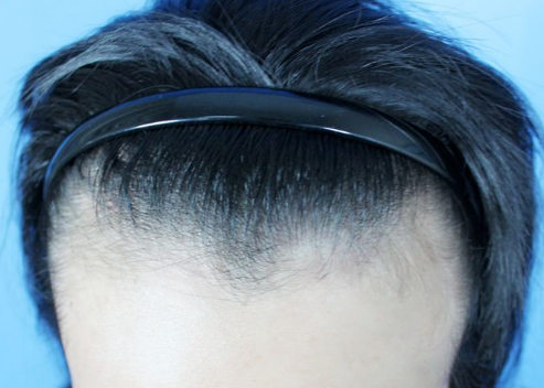 广西南宁贞韩发际线种植 理想发际线值得拥有