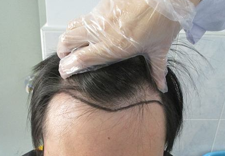 江西广济做发际线种植 好看发际线从此拥有