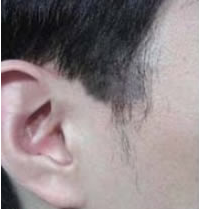 在深圳雍禾植发医院做了鬓角种植 真的没有让我失望