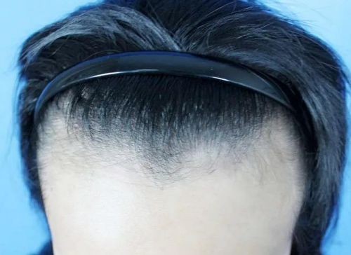 青海发际线种植哪家医院好 价格贵不贵