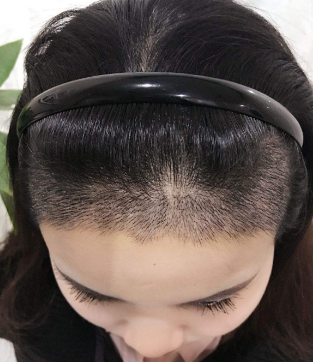 沈阳雍禾做发际线种植安全性高吗
