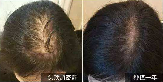 辽宁东方植发做头发加密种植真的好吗