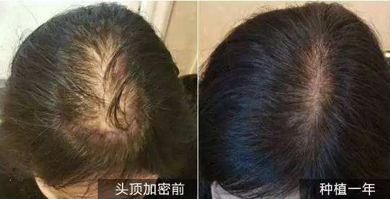 北京红旗头发加密种植优势 适宜人群