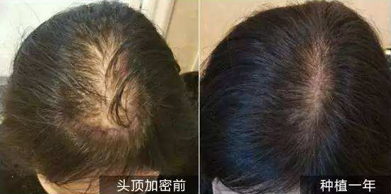 贵阳做头发加密种植哪家医院好