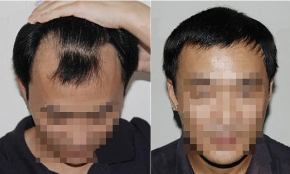 广州韩妃发际线调整效果如何