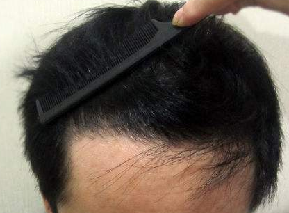 发际线是怎么种植的