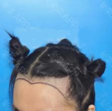 美人尖种植价格高吗 优势有哪些