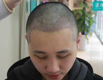 头发种植过程是怎样的 适宜人群有哪些
