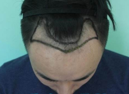 什么是头发种植 头发种植的好处有哪些