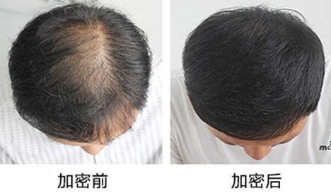 脱发是怎么回事 头发加密种植效果如何