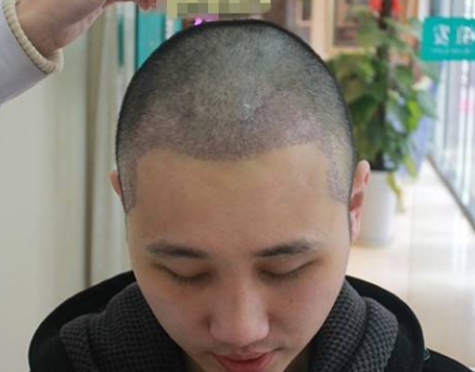 头发种植后还会再掉发吗 头发种植后脱发的原因