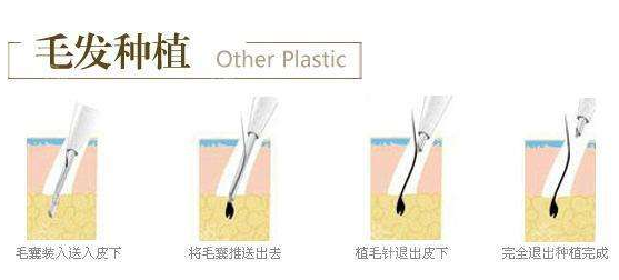 郑州美莱头发种植后多久能见效