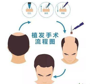深圳丽格头发种植会有后遗症吗