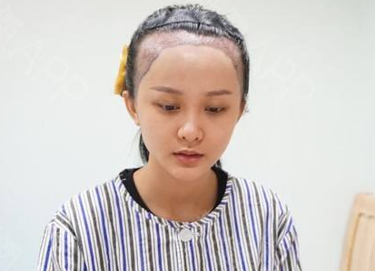 发际线种植对身体有影响吗