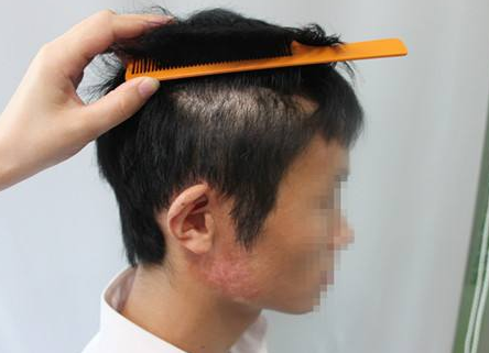 疤痕植发多久能长出头发 手术优势有哪些