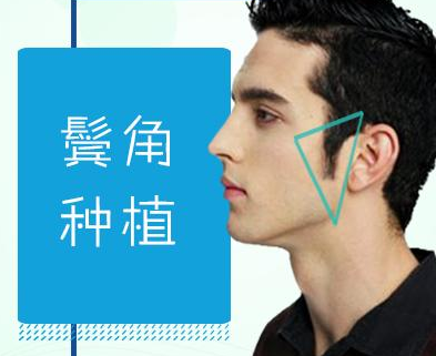 鬓角缺失怎么办 鬓角种植效果好吗