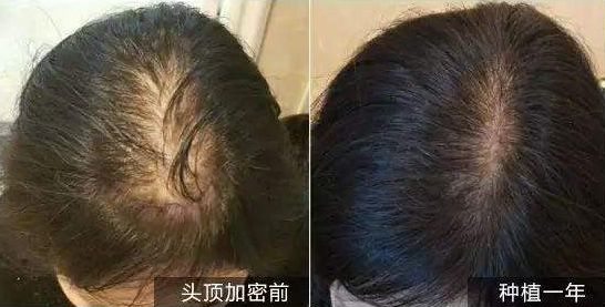 福州碧莲盛头发加密效果好不好