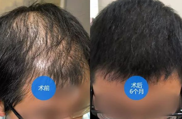 头顶头发稀少怎么办 头发加密术管用吗