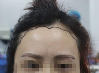 珠海新生美人尖种植 你也可以拥有明星的美人尖